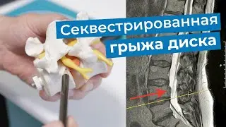 Лечение секвестрированной грыжи диска позвоночника