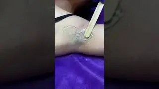 Лазерная эпиляция, лазерная эпиляция Киев