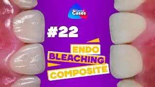 #Endodontic, bleaching, composite | BG Dental Cases #22