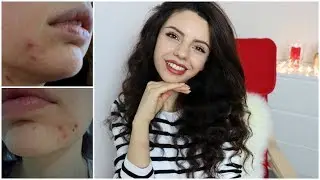 КАК ИЗБАВИТЬСЯ ОТ ПРЫЩЕЙ И ПОСТАКНЕ👊МОЕ ПИТАНИЕ И УХОД🍎