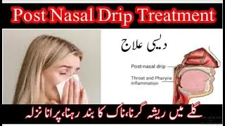 Galay Mein Keera Girna|Post Nasal Drip|Treatment