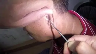 Removing Foreign Body Stuck in Man's Ear By Suctioning - What is it?