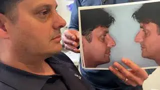 Rhinoplasty for asymmetric and crooked nose  I  Anthony Bared, MD, FACS