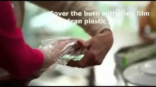 Burns