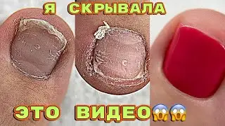 ВРОС НОГОТЬ 😱 Подногтевая мозоль / Педикюр на себе