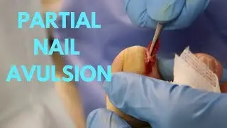 CURVED INGROWN NAIL REMOVAL!