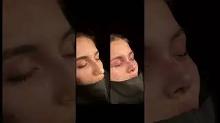 Revision Rhinoplasty (Nose Job) Surgery Before and After