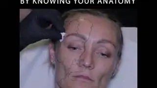Filler BLINDNESS: How To Avoid Your Worst Nightmare
