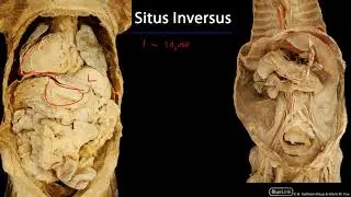 Cardio Station 4 - Situs Inversus