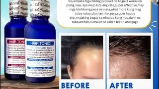 MINOXIDIL 15% hair Tonic | Product Review