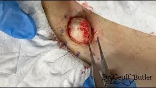 Cyst removal from the groin