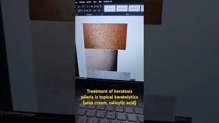 #keratosispilaris KERATOSIS PILARIS#keratosis