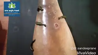 Leech Therapy For Varicose vain,Non Healing Wound,Cellulitis By Dr.Sandeep Rane