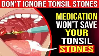 What CAUSES Tonsil Stones and How to Prevent Them – Doctors Don’t Tell You THIS!