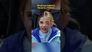 The girl was stabbed in the eye by a fishhook.