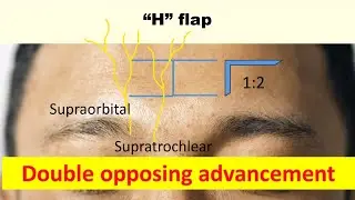 How to design double opposing advancement flaps (H flap)