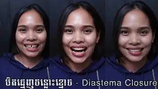 បិទធ្មេញចន្លោះ ខ្មោច /diastema closure/ DOKTER SOK HENG / គ្លីនិកធ្មេញសុខ Telegram :  070525223