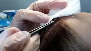 Результаты первого сеанса мезотерапии волосистой части головы
