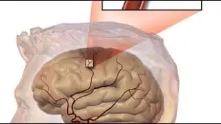 Stroke | Wikipedia audio article