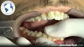 Inferior opening - SlimClear
