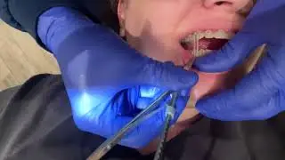 [4K] How-To put on Rubber Bands on Braces! Slo-Motion included! #bracestips