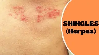 Shingles: Symptoms & Treatment | Eye Shingles | Post Herpetic Neuralgia | Shingles Vaccine