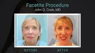FaceTite, the Fabulous Non-Surgical Solution for Jaw and Neck