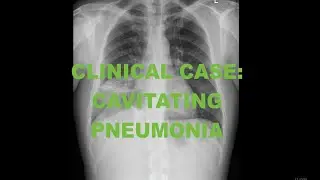 Clinical Case - Cavitating pneumonia - Chest Xray and CT Scan - Radiology tutorial
