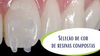 Seleção de cor de resina composta