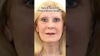 Amazing 6 Week Facelift Transformation - She looks 20 years younger! #shorts #facelift