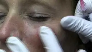 The Truth About Cheek and Tear Trough Filler Injectionby Dr. Joe Niamtu, III Part 2.wmv