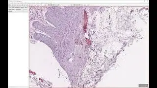 Гипоганглиоз тонкой кишки