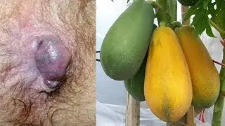 Ways to treat hemorrhoids naturally at home with papaya