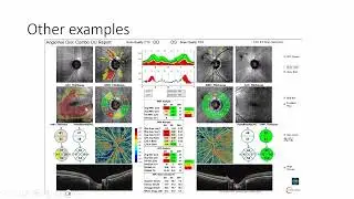 Solix Glaucoma Visionix - Odwire webinar - Mike Cymbor - August 29 2024