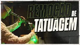 Processo de remoção de tatuagem (Antes e depois)
