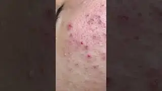 HOT HOT HOT ACNE BIG GIANT - ĐIỀU TRỊ MỤN ĐÀ NẴNG MAI NGỌC