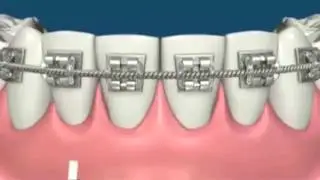 Flossing with braces - Miskin Ajax Dental