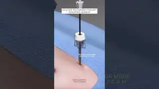 How to Operate an Appendectomy 