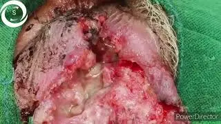 Maggots in Eye