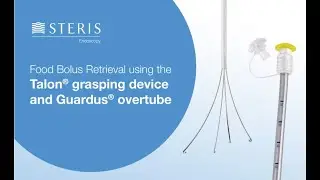 Food bolus retrieval using the TALON™ Grasping Device and GUARDUS™ Overtube | STERIS
