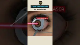 How LASIK (Laser Eye Surgery) works ~  #shorts #3d #animation #shortvideo #youtubeshorts