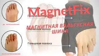 Магнитная вальгусная шина MagnetFix,Шина magnetfix купить