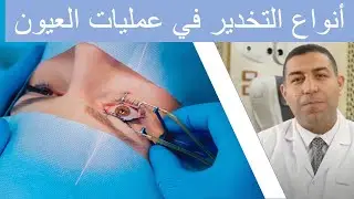 أنواع التخدير في عمليات العيون