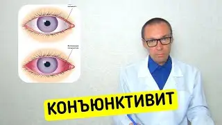 Аллергический Конъюнктивит - от А до Я
