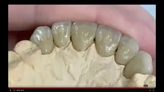 Zirconia Singles Anterior New Technique!