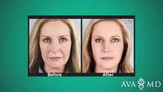 Are Sculptra Injections Right for You?