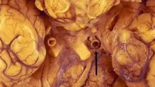 NEUROPATOLOGIA - NEUROPHATOLOGY