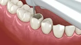 Çocuk Diş Dolgusu