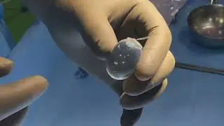 SEBBIN silicone gel-filled testicular implant Surgery