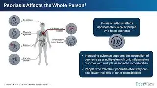 Staying on Target Against Moderate to Severe Psoriasis